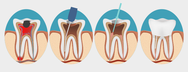 Kanal Tedavisi (Endodontik)